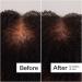 Shop Act+Acre 0.25mm Scalp Dermaroller for Thicker + Fuller Looking Hair - Standard size Online - Best Price & International Shipping - Buy Online on GoSupps.com