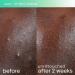 Shop Skinfix acne+ triple threat set with Salicylic Acid (BHA) + Niacinamide with B-L3 Online - Best Price & International Shipping - Buy Online on GoSupps.com