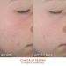 Shop Dr. Dennis Gross Skincare Alpha Beta On The Spot Eliminator 2% Salicylic Acid Acne Treatment Gel - 1 oz / 30 ml Online - Best Price & International Shipping - Buy Online on GoSupps.com