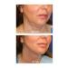 DR Lipo Mesotherapy Double Chin Melting Cheek Thinning Price is for 1 Vial (INJECTORS AND ANESTHESIA CREAM) - Buy Online on GoSupps.com