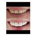 FAST WHITE NATURAL TEETH WHITENING Economical 10 Ml Teeth Whitening and Tartar Cleaning - Buy Online on GoSupps.com