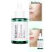 BEAUSTA Soothing Anti-Acne Serum with Cica Centella for Sensitive Skin