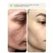 KEYCLEAR Facial serum from acne and black dots - Buy Online on GoSupps.com