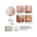 Eelhoe nasal mask for removing acne - Buy Online on GoSupps.com
