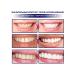 Eelhoe dazzling white dental veneers - Buy Online on GoSupps.com