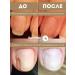 Apitextura Remedy for nail fungus serum stop onycholisis - Buy Online on GoSupps.com