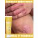 Ointment from psoriasis from eczema from dermatystabystro and effectively