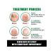 Jaysuing treatment of nail fungus tool for nail care - Buy Online on GoSupps.com