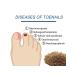 Eelhoe fungus of a gray nail thickening restoration manual ... - Buy Online on GoSupps.com