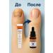 ZAKALEZ Cosmetic tool from nail fungus - Buy Online on GoSupps.com