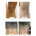 Gintensive Vitiligo cream for pigmented white stains of the skin - Buy Online on GoSupps.com