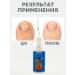 muva Remedy for ingrown nails on the legs of pedicure medical - Buy Online on GoSupps.com