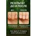 MILINABOSS Remedy for nail fungus eliminates darkening and itching 1pc - Buy Online on GoSupps.com