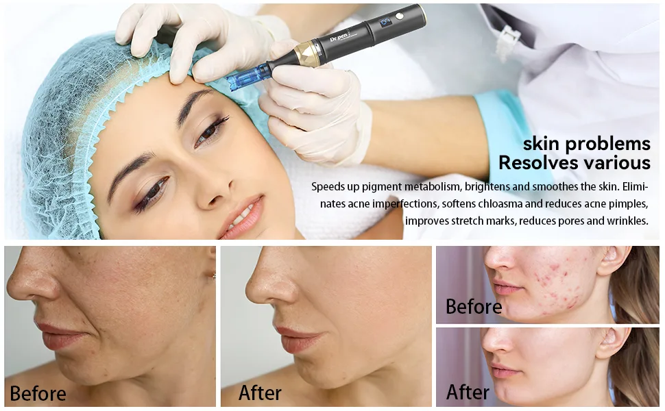 Dr.pen A8S Wireless Microneedling Pen Adjustable 0-0.25mm Micro Needling Pen LED Display Screen with 2 Replacement Cartridges(18pin) A8S-UK black - product information 20
