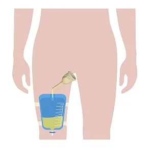 25-Units Rubber Urinal Bag Male External Catheters | Condom Catheters Single use (Large 30 mm 1.2 Inches) - Rubber Urinal Bag Male External Catheter Single