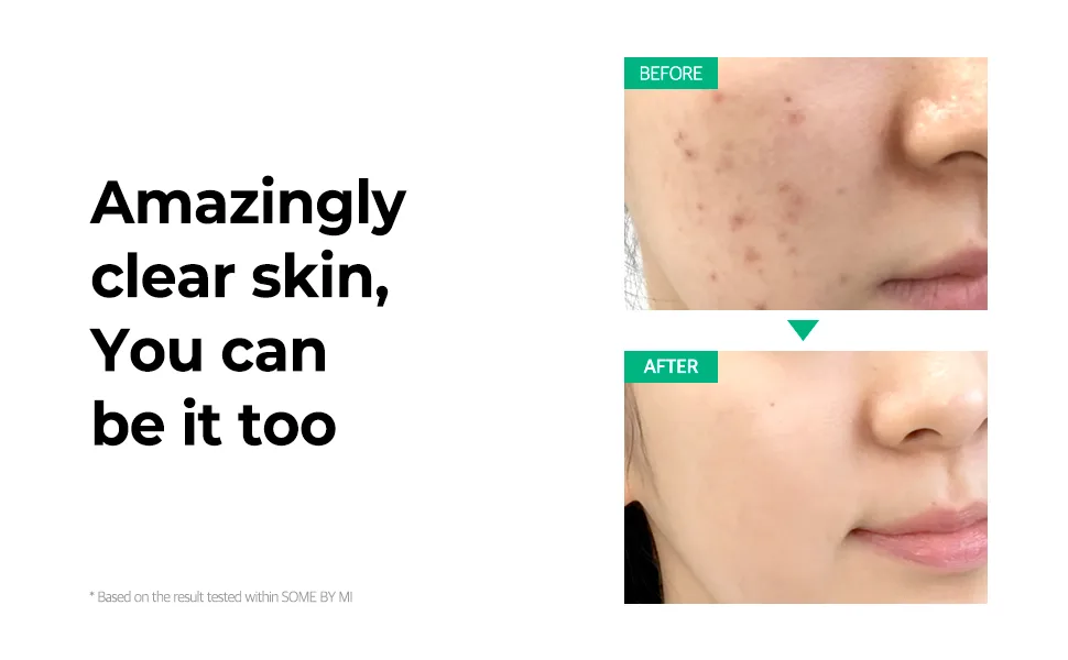 Some By Mi AHA. BHA. PHA 30 Days Miracle Toner 150 ml - SOME BY MI Miracle Toner Result