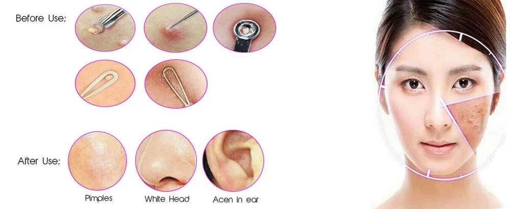 YNR Professional Blackheads Whiteheads Comedone Remover Extractor Facial Tool Flat and Round Wired Ends Surgical Stainless Steel - Needle Acne Blackhead Remover Pimple Extractor