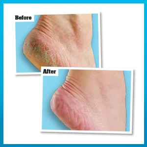 O'Keeffe's Healthy Feet 80ml (5 Pack) 85 g (Pack of 5) Single - Before & After