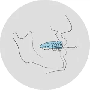 Dr. Brux - Premium night guard individually adjustable - against grinding bruxism and CMD - Dr. Brux Anpassung Schritt 3