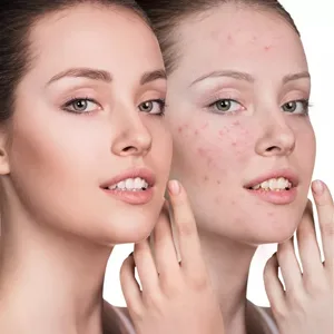 Moses of blackheads - product information 8