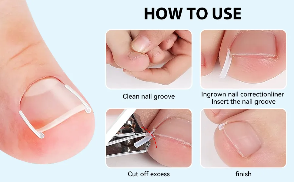 152 Pieces Ingrown Toenail Tool Set Toenail Correction Patch for Ingrown Toenails (Ingrown Toenails-7) - Eingewachsene Zehennägel