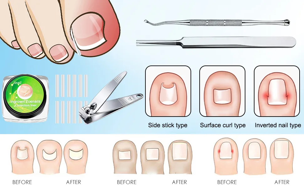152 Pieces Ingrown Toenail Tool Set Toenail Correction Patch for Ingrown Toenails (Ingrown Toenails-7) - Eingewachsene Zehennägel