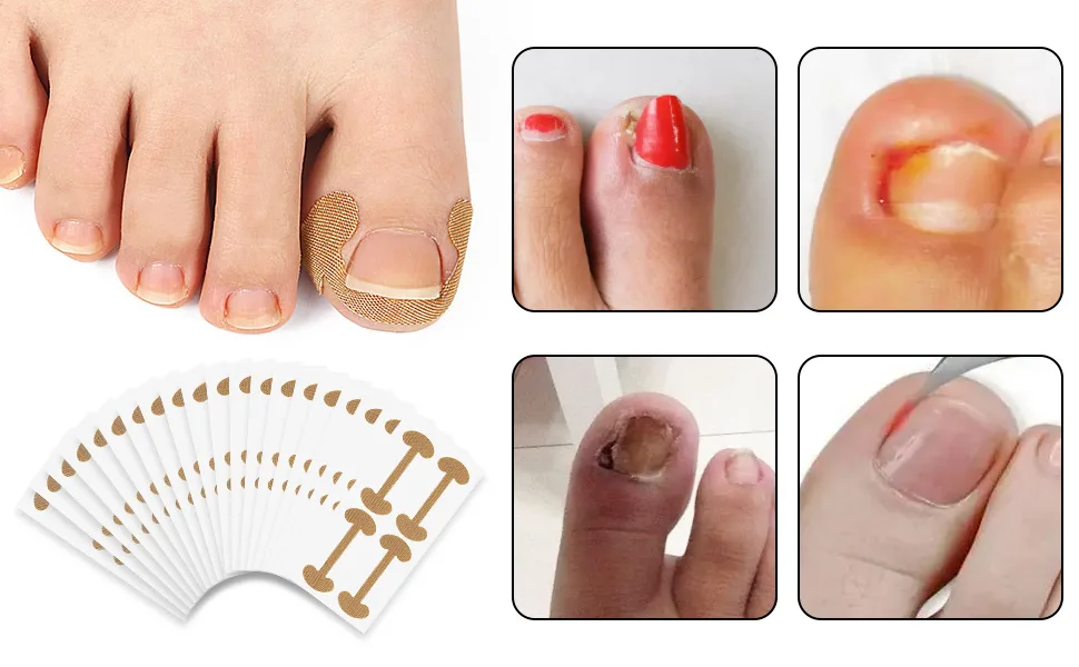80 pieces toenail patch toenail correction patch ingrown toenails correction patch ingrown toenails pavement correction sticker toe nail for treatment protects toenails - Zehennagel Patch