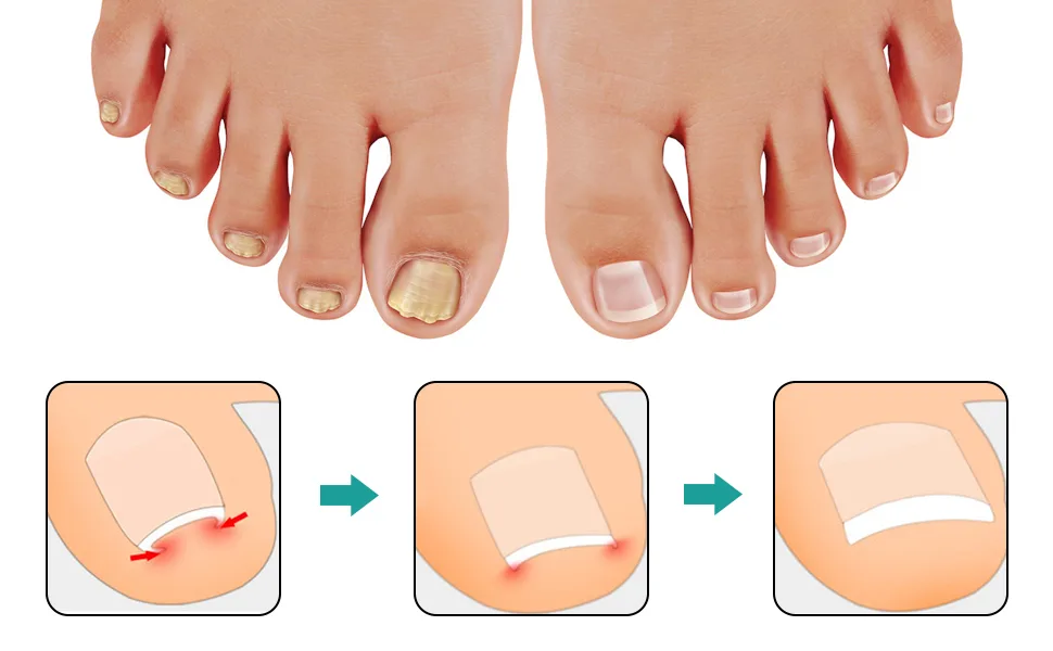 80 pieces toenail patch toenail correction patch ingrown toenails correction patch ingrown toenails pavement correction sticker toe nail for treatment protects toenails - Zehennagel Patch