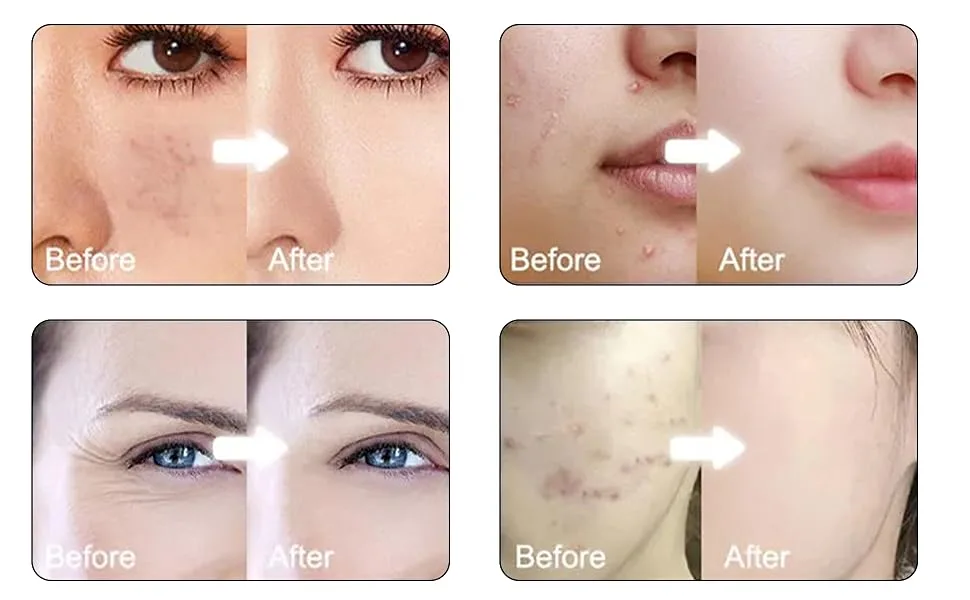 Olakin Dermaroller 0.5mm micronadel roller professional microneedling for internal skin regeneration effective against acne wrinkles stretch marks and hyper-pigmentation - Roller
