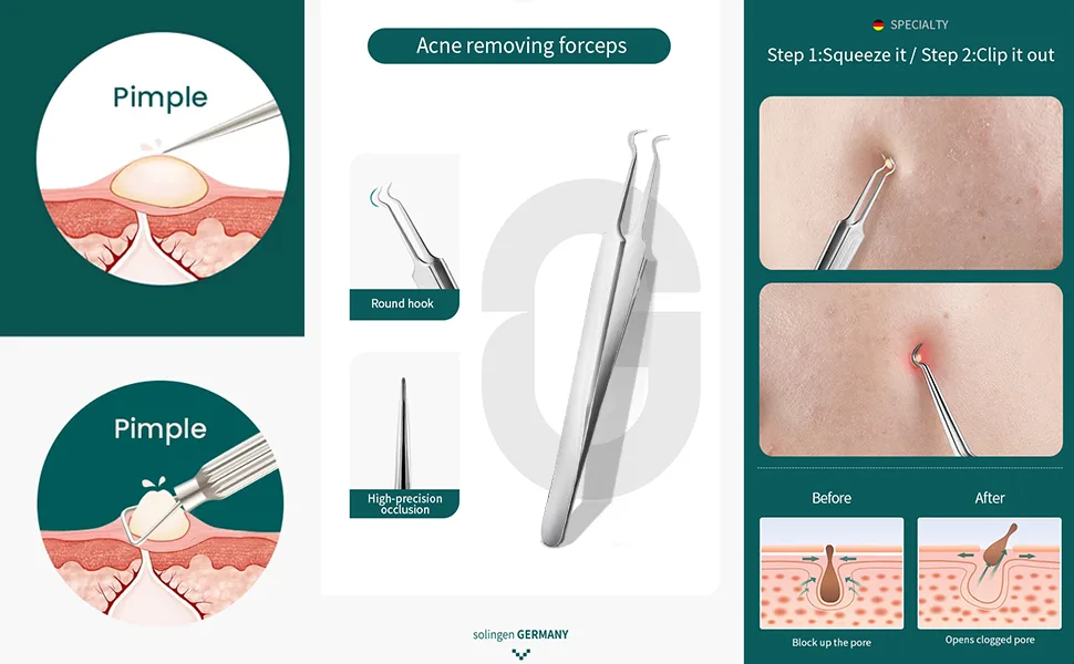 Nacerlary 10 Different Needle Tweezers Blackhead Puller Tool Set - product information 2