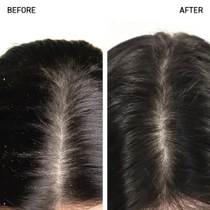 Bosley Scalp Relief Anti-Dandruff Shampoo with Pyrithione Zinc 8.5 fl oz (250 ml) - zinc