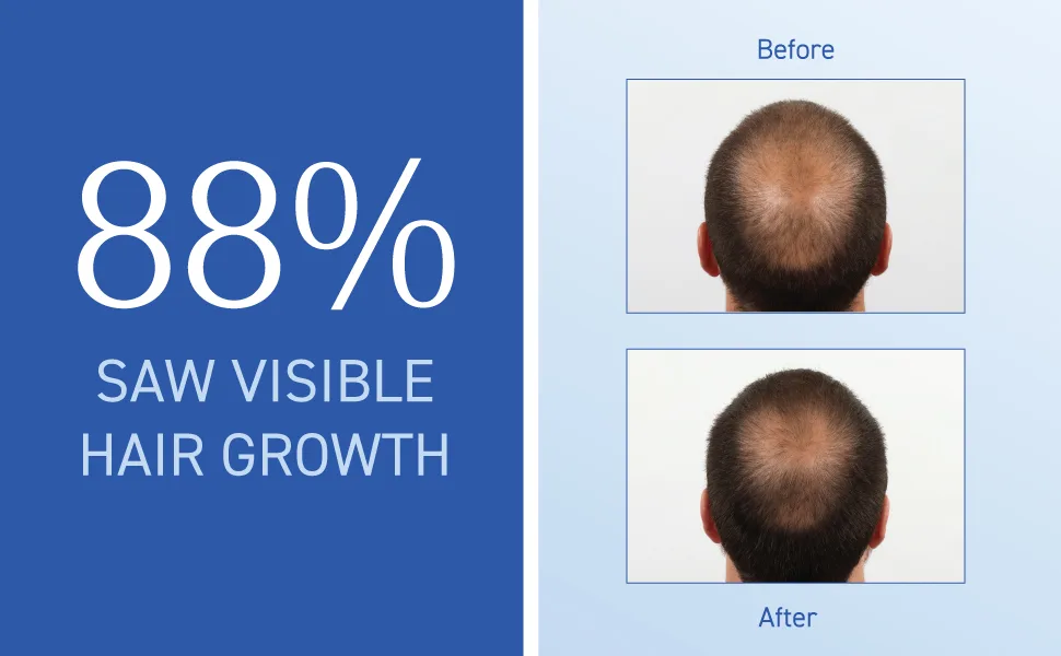 Bosley Bos-Revive Volumizing Conditioner Step 2 Non Color-Treated Hair 10.1 fl oz (300 ml) - 88% visible growth regrowth