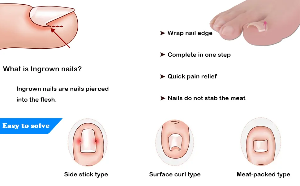 Toe nail correction ingrown toenails tool set toenail patch corrector pedicure tools correction sticker zeh nail toenail smooth correction patch paronychy corrector - product information 2