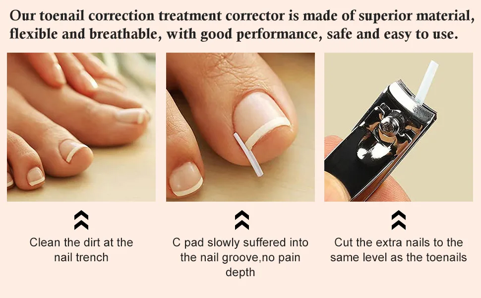 Toe nail correction ingrown toenails tool set toenail patch corrector pedicure tools correction sticker zeh nail toenail smooth correction patch paronychy corrector - product information 3