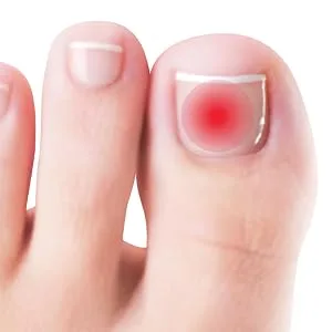 TecniWork nails feet - 15 ml - Auf die Oberfläche des Nagels auftragen.