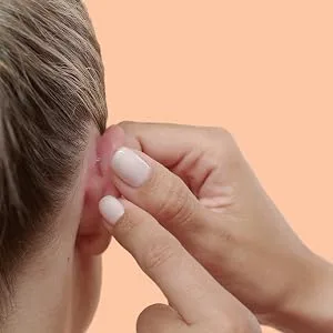 Otostick Aesthetic Ear Correction (3 pieces) - otostick