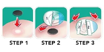 Dr Scholl's Duragel Callus Removers, 4 Cushions and 4 Medicated Discs, (Packaging May Vary) Callus Remover Single - How To Use
