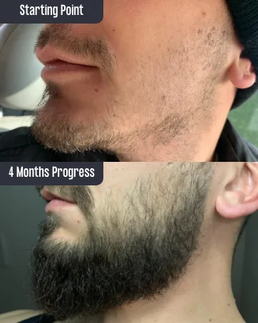 Copenhagen Grooming Set for Bart growth-the original beard growth set for a fuller stronger beard.With a proven growth activator serum dermar roller-250 days 8-part set - Das erste Bartwuchs-Set der Welt