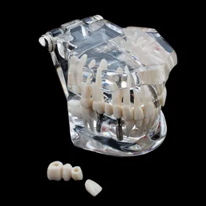 Cocoarm dental care model removable tooth model doctor dental demo implant dentist teaching study model transparent teaching tool for dentist demonstration - product information 28