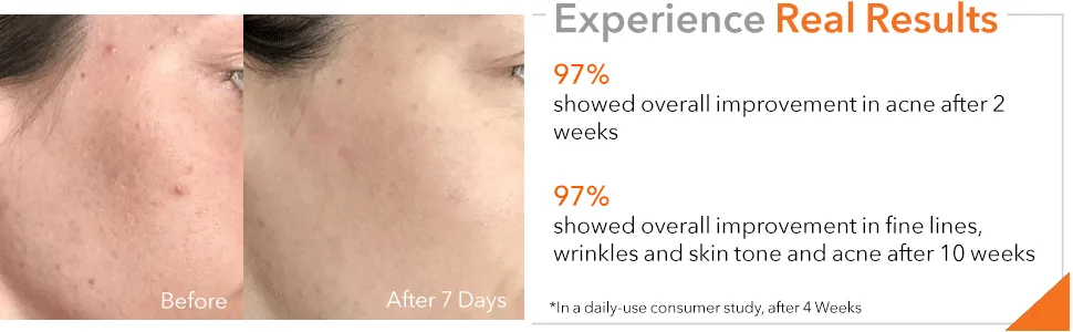 Dr. Dennis Gross Alpha Beta Universal Daily Peel: for Uneven Tone or Texture and Fine Lines or Enlarged Pores, (60 Treatments) 60 Count - Alpha Beta Universal Daily Peel 60