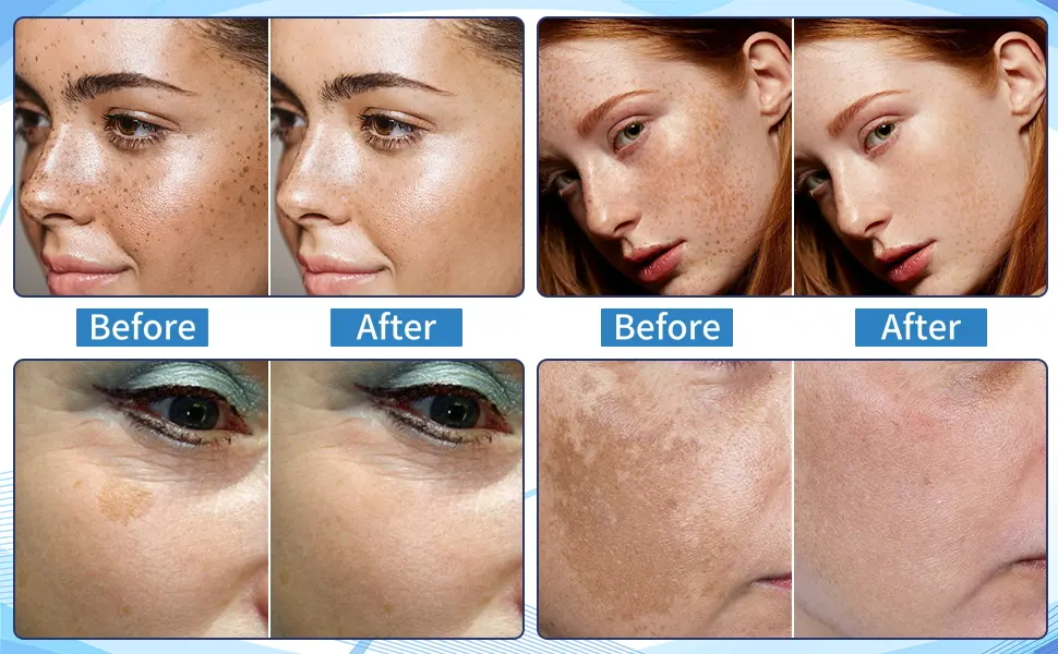 Dark Spot Remover for Face Hyperpigmentation Treatment. Dark Spots, Melasma, Freckle, Sun Spots Removal Dark Spot Corrector Cream for Women and Men - Before and After