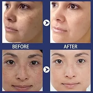 Dark Spot Remover for Face Hyperpigmentation Treatment. Dark Spots, Melasma, Freckle, Sun Spots Removal Dark Spot Corrector Cream for Women and Men - product information 3