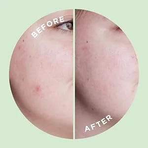 HYPERFADE by ZitSticka, Microdart Patch to Fade Post-Zit Dark Spots - product information 4