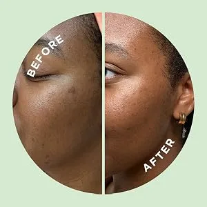 HYPERFADE by ZitSticka, Microdart Patch to Fade Post-Zit Dark Spots - product information 5