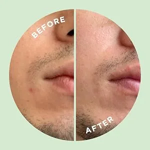 HYPERFADE by ZitSticka, Microdart Patch to Fade Post-Zit Dark Spots - product information 6