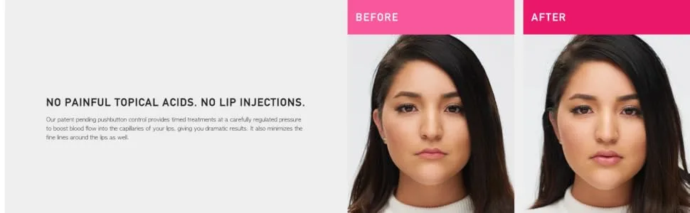 JuvaLips | Original White Lip Plumping Device & Plumping Serum | Made in the USA - JuvaLips Lip Plumping Device Before and After Results