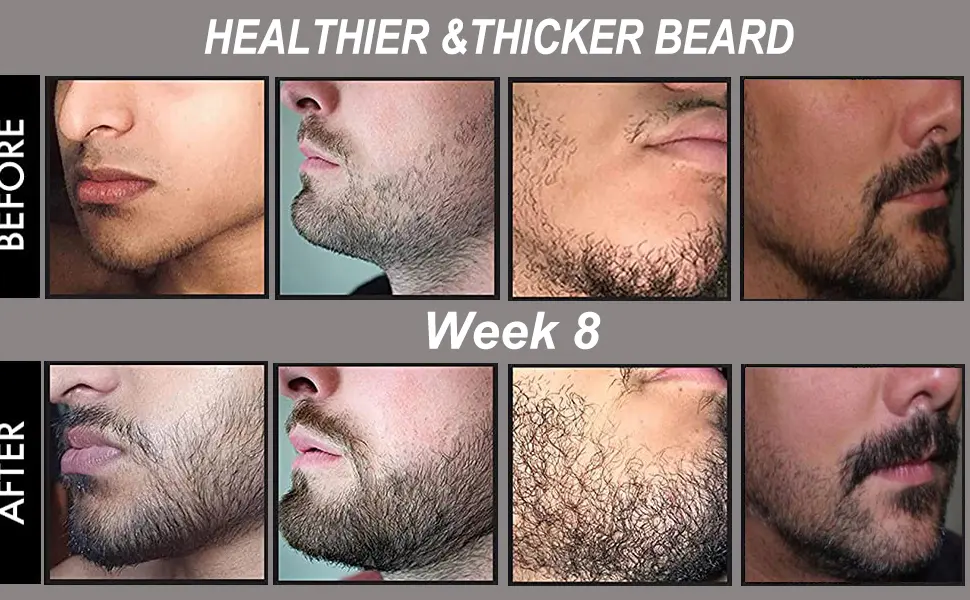 Angel Kiss Beard Derma Roller for Beard Growth for Men, Titanium Microneedle Roller for Patchy Hair Beard Growth for Home w/Storage Case Black0.5 - beard derma roller