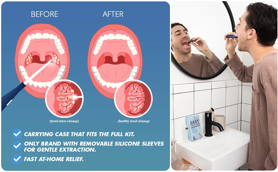 Dr. Frederick’s Original Easy Tonsil Stone Remover Kit - Fast Painless Tonsillolith Removal Tool - Fight Bad Breath - Pick and Oral Irrigator - 8 Pieces - tonsil stone remover