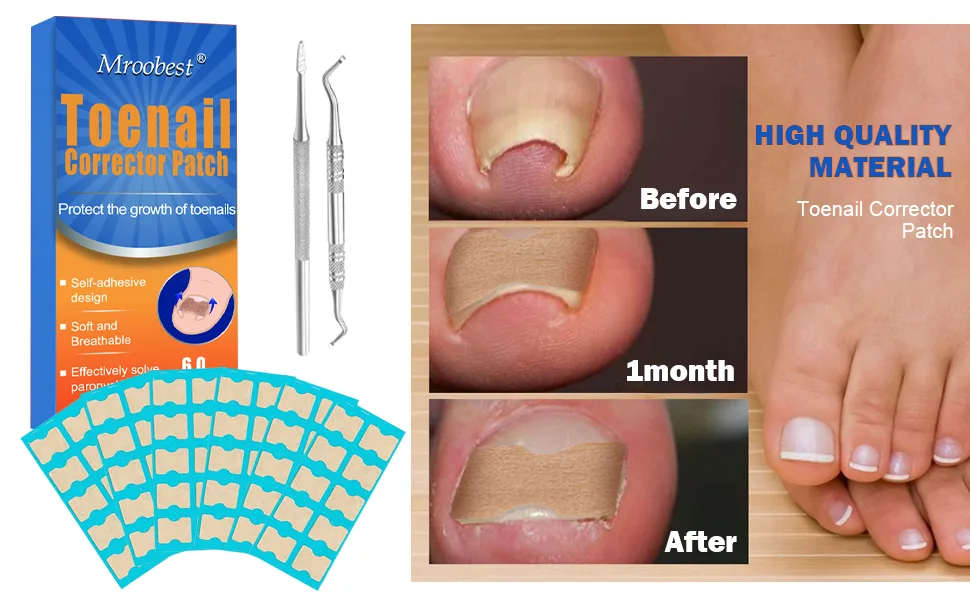 Toenail Corrector Patch, Ingrown Toe Nail Correction Sticker, Glue-Free Ingrown Toenail Corrector Strip, With Nail Correction Tool, 60PCS - product information 3