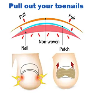 Toenail Corrector Patch, Ingrown Toe Nail Correction Sticker, Glue-Free Ingrown Toenail Corrector Strip, With Nail Correction Tool, 60PCS - product information 6